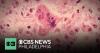 Delaware declares measles outbreak after 2 additional cases