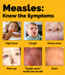 Health Officials Investigating Possible Measles Case; Hospital and First Responders Taking Safety Precautions in St. Mary’s County