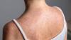Delaware Measles Cases Reach Outbreak Level