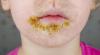 Impetigo cases among Dutch children surge higher and earlier than usual