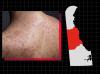 Delaware declares measles outbreak days after first case
