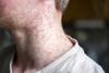Maryland confirms 3 new measles cases, warns of possible exposures