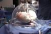 FDA Approves TorEx: Hospital-Based Device Rescues Lungs Once Deemed Unfit