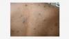 Arizona confirms first case of deadlier mpox strain; 'risk to public is low'