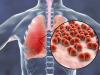 Abera seeks clinical trial clearance for AB-01.12
