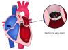 OU Health: Double Pulmonary