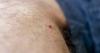 Amid summer surge, Wisconsin scientists need tick samples