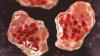 Measles cases rise in Maryland