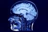 UVA researchers find new approach to treating a common form of brain cancer
