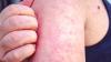 Cases of this disease just hit a startling new high