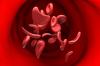 Gene therapy transforms life of Maryland sickle cell patient