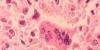 Measles cases hit record high nationally, but Las Vegas cases remain at zero