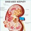 Gene discovery changing kidney disease treatment among Africans —Ajayi
