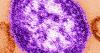 Patient with measles was at MultiCare hospital in Yakima on July 13
