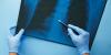 AI-powered TB screening project aims to transform diagnosis