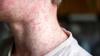 Contagious virus warning for World Cup fans returning from US as cases hit 35-year high