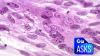 Can Vaccines Really Help Prevent Dementia?