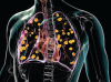 <![CDATA[Histoplasmosis: A Common Infection Hiding in Plain Sight]]>