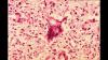 US measles hits a 35-year high: One front in a global unraveling of public health