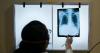 New tuberculosis blood test could reduce spread of killer infectious disease