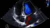 Cardioband Scrutiny Widens Across European Hospitals