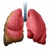 <![CDATA[AI-Based Pan-TEAD Inhibitor Wins FDA Fast Track Designation in Mesothelioma]]>