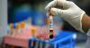 How simple test for killer cholesterol can prevent fatal heart attack