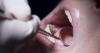 Young people brushing dental health aside, experts warn