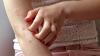 Antihistamines Fail to Relieve Eczema Symptoms