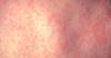 Ask Dr. Nandi: Measles cases in the U.S. are at a 35-year high