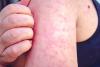 Outbreaks tests US public health system amid funding cuts, vaccine resistance