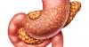 Lifestyle changes can reduce pancreatic fat, lowering diabetes risk: Study