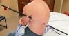 Montana man impaled by a trekking pole