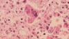 Ohio reports state's third measles outbreak of 2026