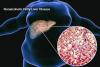 Fatty liver disease: A silent killer ignored by many