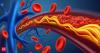 India, China bore one-third of global 'bad' cholesterol burden in 2023: Study