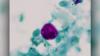 Kentucky, Indiana health departments reporting higher numbers of cyclosporiasis cases
