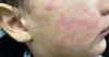 Measles case found at Union Hospital