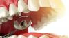 Scientists discover drill-free breakthrough to stop cavities