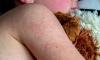 String of Outbreaks Tests US Public Health System Amid Funding Cuts, Vaccine Resistance (8-1-2026)