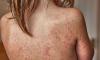 Getting frequent colds and fevers increases children's chance of developing eczema, study reveals