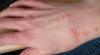 Dutch scabies cases stay elevated as treatment proves difficult