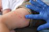 The U.S. Has Already Surpassed Last Year’s Number of Measles Cases. Here’s What’s Driving the Surge.