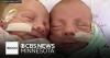 Minnesota woman gives birth to ultra rare mono mono twins