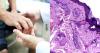 Reports indicate an increase in cases of leprosy in Florida