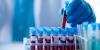 New blood tests accurately detect Alzheimer’s disease in adults with Down syndrome