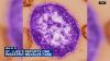 Child among 2 being treated for measles in Lehigh County, health officials say