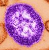 Merced County Monitoring Farmworkers Exposed to Measles During Arizona Outbreak