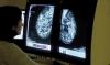 Women under 50 at risk of breast cancer are not being referred - study