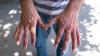 Fears contagious mpox strain that causes painful blister rash silently spreading in UK amid ‘rapid’ outbreak